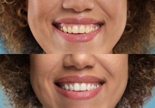 Before and after teeth whitening results.