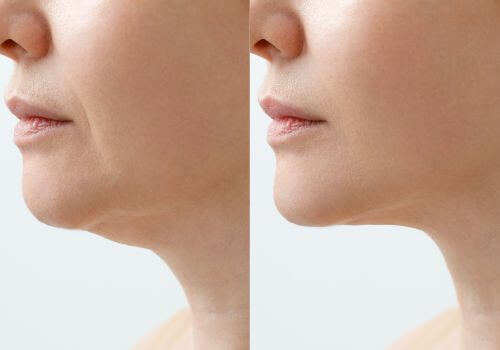 Before and after chin ptosis treatment.