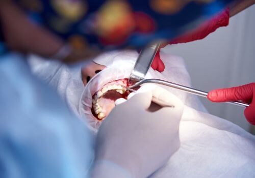 Sinus lift in male patient.