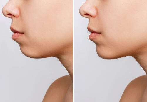 Chin before and after genioplasty results.