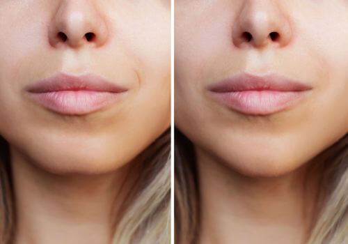 Chin before and after genioplasty results.