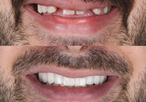 Before and after of major dental work for a man.