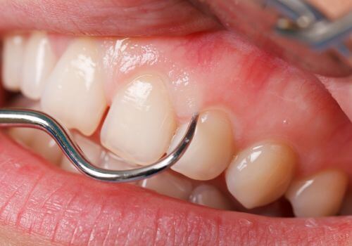 Healthy mouth getting gums measured by dentist.