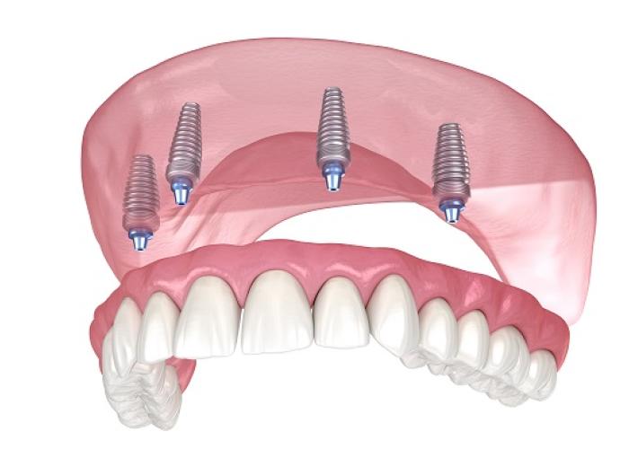 When Are All-on-4 Dental Implants Right for You?