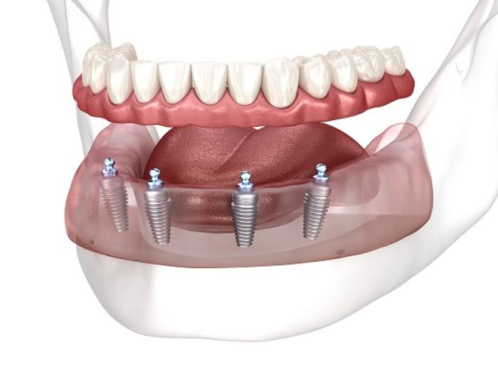 How Long Do All-on-4 Implants Last?