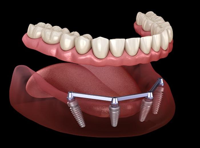 All-on-4 Implants for Missing Teeth