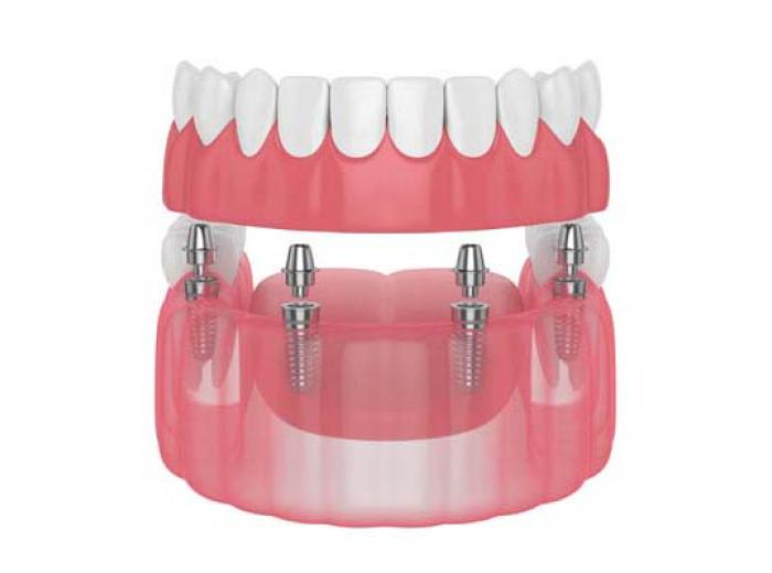 Transform Your Smile with Natural-Looking All-on-4® Implants