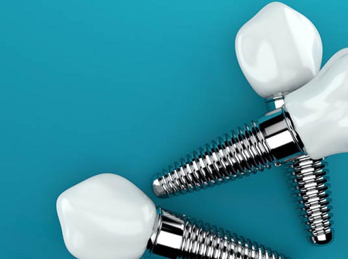 Understanding the Tooth Replacement Timeline with an Implant Dentist