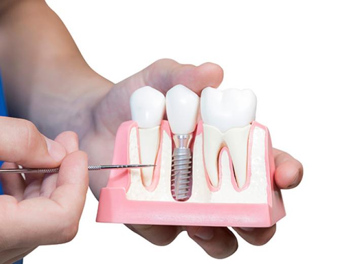 Good Candidates for Implant Dentistry