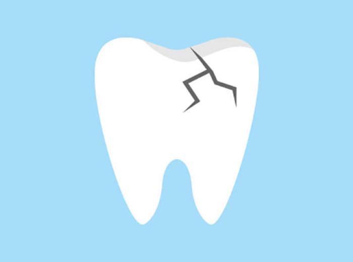 Ask an Implant Dentist About Damaged Tooth Replacement