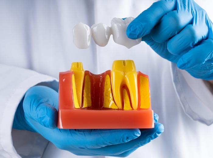 Dental Bridge Solutions for Missing Teeth
