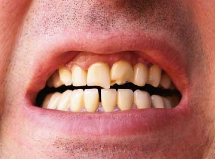 Dental Restoration Treatments for a Broken Tooth