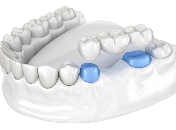 Dental Bridges for Missing Tooth Replacement