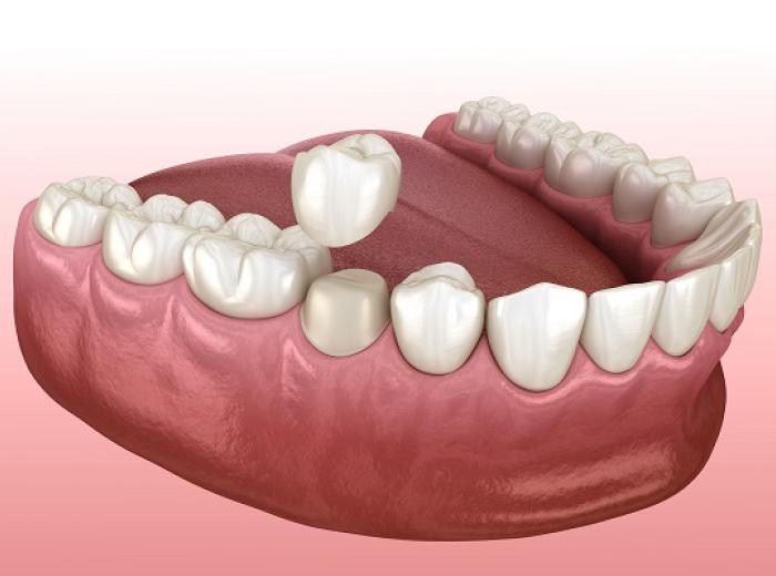 Dental Crowns for Tooth Restoration in Jenkintown