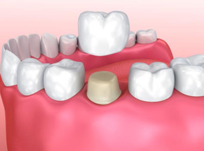 Dental Crowns for Dental Trauma Treatment in Jenkintown
