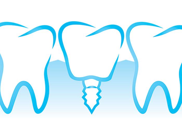 Dental Implant Restorations: Lifespan & Care Tips