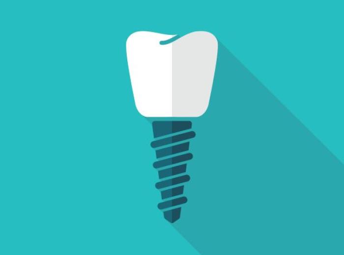 Dental Implants for Missing Teeth Replacement in Jenkintown