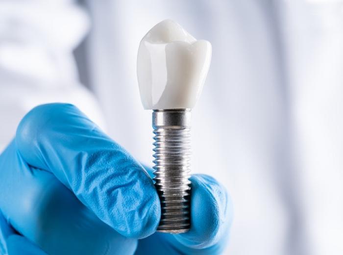 Dental Implants: Replace Missing Teeth at MVP Family Dental