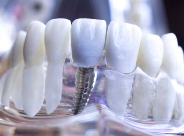 Dental Implants to Replace Missing Teeth