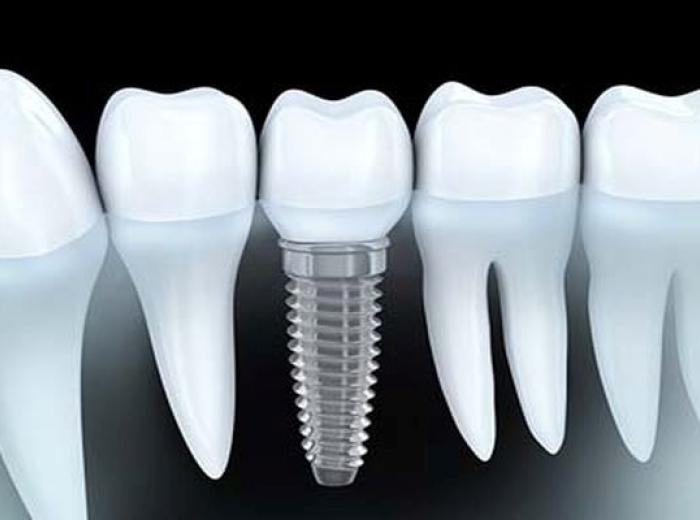 Dental Implant FAQs