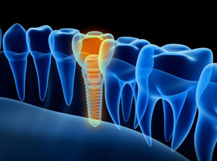 Dental Implants in Jenkintown: Signs You Need Them