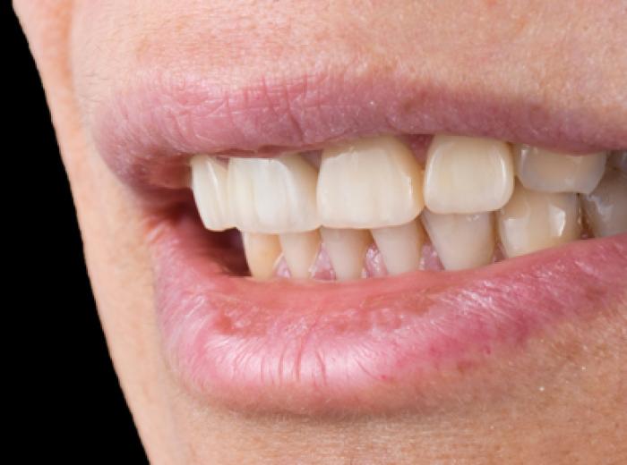 Dental Restoration Options to Replace Missing Tooth