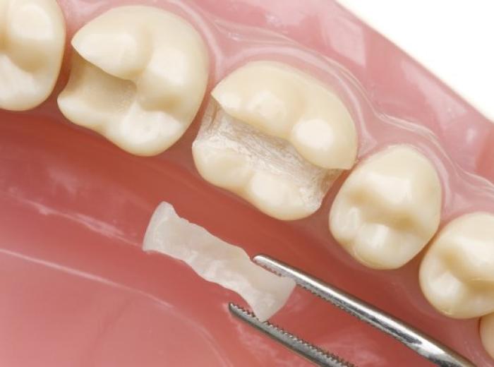 Dental Sealants: 3 Ways to Prevent Cavities for Your Family