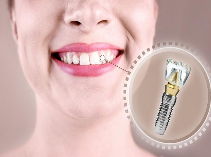 Dental Implants vs Natural Teeth: Key Differences Explained