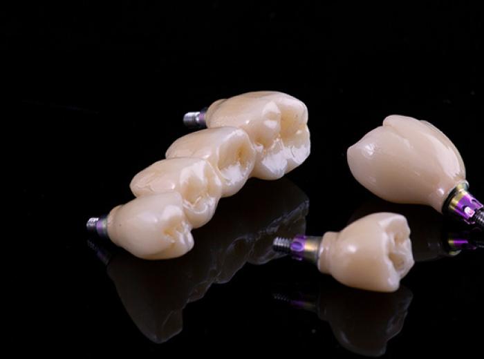 Implant Dentistry for Missing Teeth: Options in Jenkintown