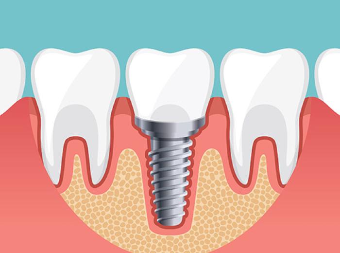 Dental Implants for Single Tooth Replacement in Jenkintown