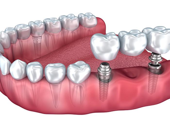 Dental Bridges & Implant Dentistry Options in Jenkintown