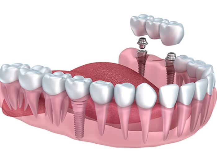 Dental Implants & Implant-Supported Bridges in Jenkintown