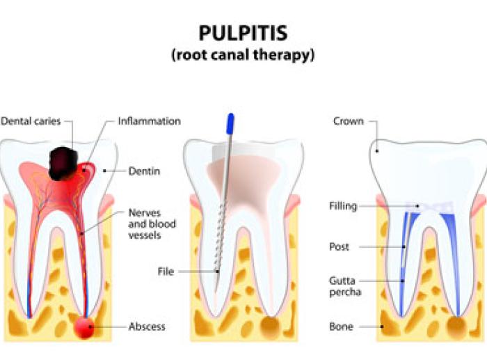 Root Canal Dentist in Jenkintown