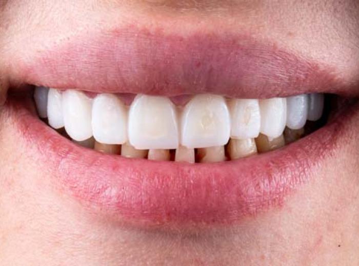 Transform Your Smile with a Makeover