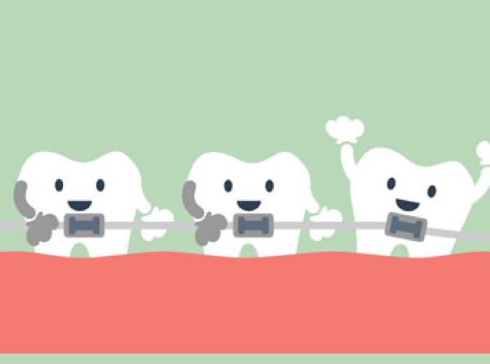 Teeth Straightening Options in Jenkintown