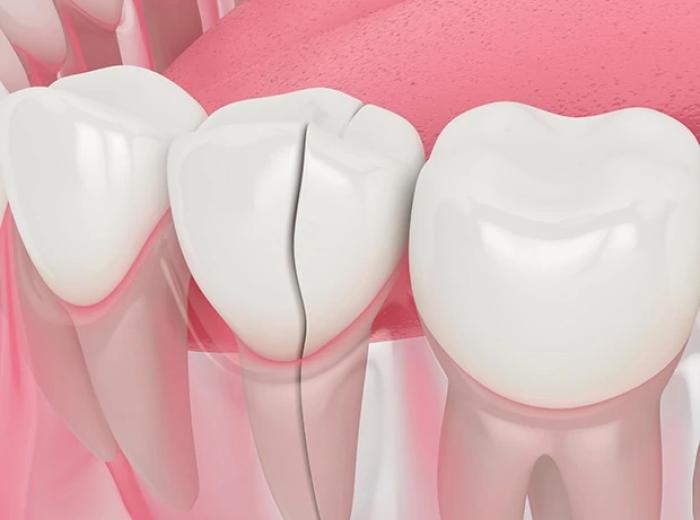 Dental Root Fracture Symptoms & Treatment in Jenkintown, PA