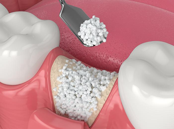 Bone Graft for Dental Implants: Essential Insights