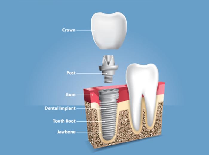 Dental Implants & Crown Placement for Missing Tooth Replacement